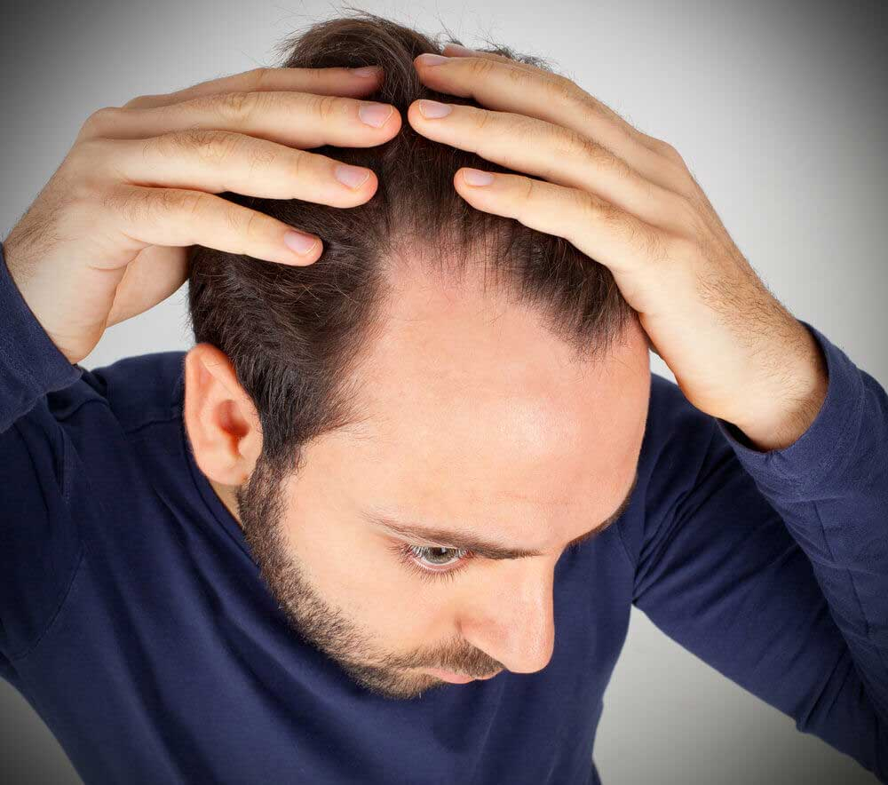 Erkeklerde Saç Dökülmesine Ne İyi Gelir ? Menhane | Türkiye&amp;#039;Nin Yeni fiçin Koparak Dökülen Saç Çıkar Mı