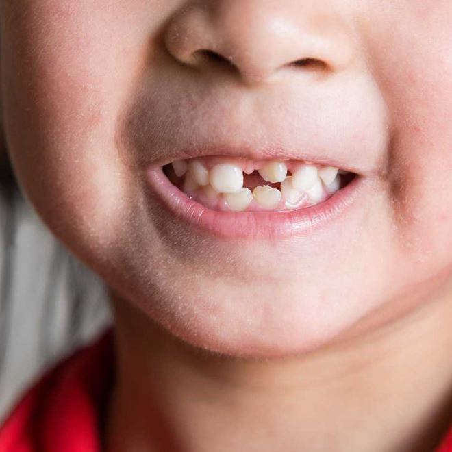 Rüyada Diş Çıkması Ne Anlama Gelir? ile Rüyada Beyaz Diş Görmek