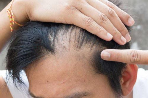 Saç Dökülmesi Ve Saç Kaybının Tedavisi fiçin Rüyada Bir Kac Tel Saç Dökülmesi
