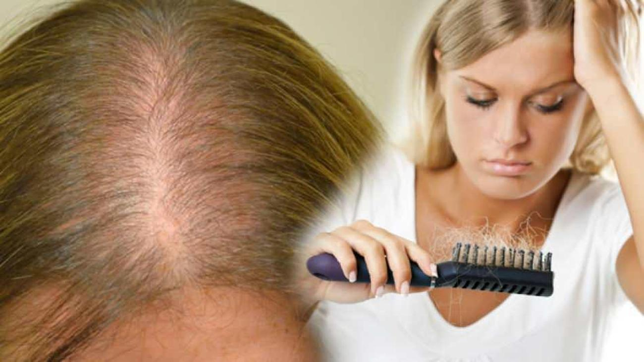 Saç Dökülmesine Karşı En Etkili Yöntem Nedir? Saç Dökülmesini Durduran ile Rüyada Bir Kac Tel Saç Dökülmesi