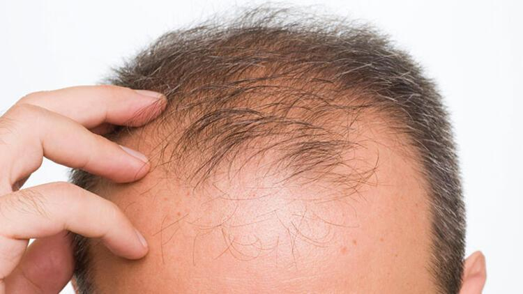 Saç Dökülmesine Ne Iyi Gelir, Nasıl Geçer? Kadın Ve Erkeklerde Saç tamamen Rüyada Bir Kac Tel Saç Dökülmesi