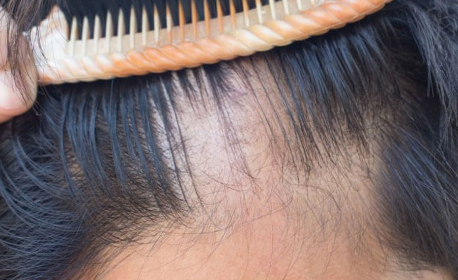 Saç Dökülmesinin Belirtileri Nelerdir? | Netra | İlaç | Kimya | Kozmetik ile Rüyada Bir Kac Tel Saç Dökülmesi